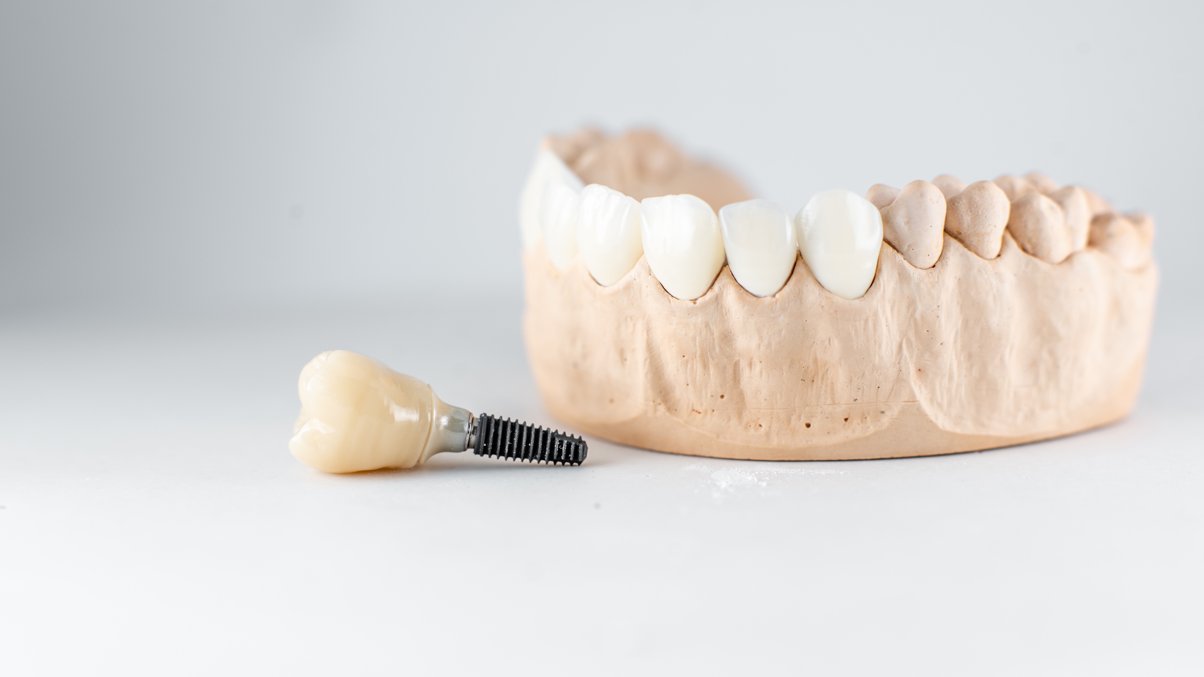 Post Implant Placement Instructions